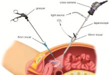Λαπαροσκόπηση: Όλα όσα χρειάζεται να γνωρίζετε