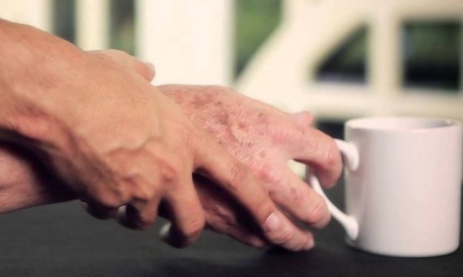 Πώς η καφεΐνη σχετίζεται με την ασθένεια Πάρκισον