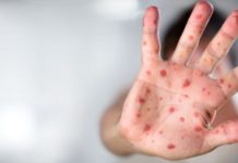 Θερίζει η ιλαρά στην Ελλάδα - Νέο κρούσμα σε 5χρονο κοριτσάκι