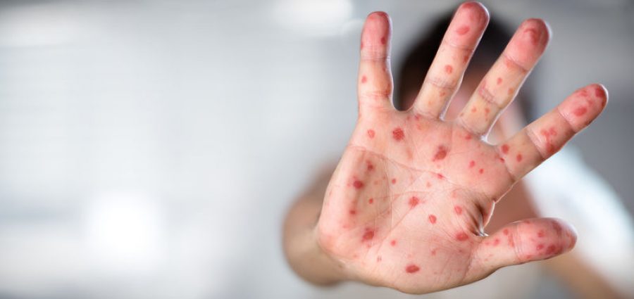 Θερίζει η ιλαρά στην Ελλάδα - Νέο κρούσμα σε 5χρονο κοριτσάκι