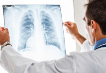 Αυτά είναι τα σημάδια του πρώιμου καρκίνου στον πνεύμονα