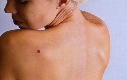 Εμφύτευμα ανιχνεύει πρόωρα τον καρκίνο εμφανίζοντας μια ελιά