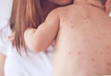 Επιδημία ιλαράς στην Ευρώπη - Χιλιάδες κρούσματα στην Ελλάδα