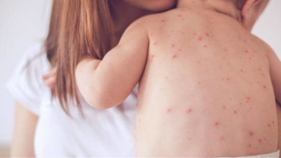 Επιδημία ιλαράς στην Ευρώπη - Χιλιάδες κρούσματα στην Ελλάδα